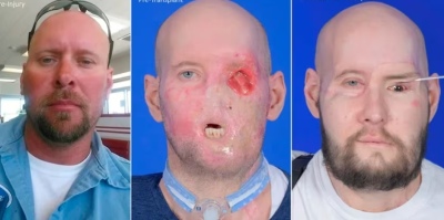 Se realiz&oacute; el primer trasplante de ojo completo en el mundo!