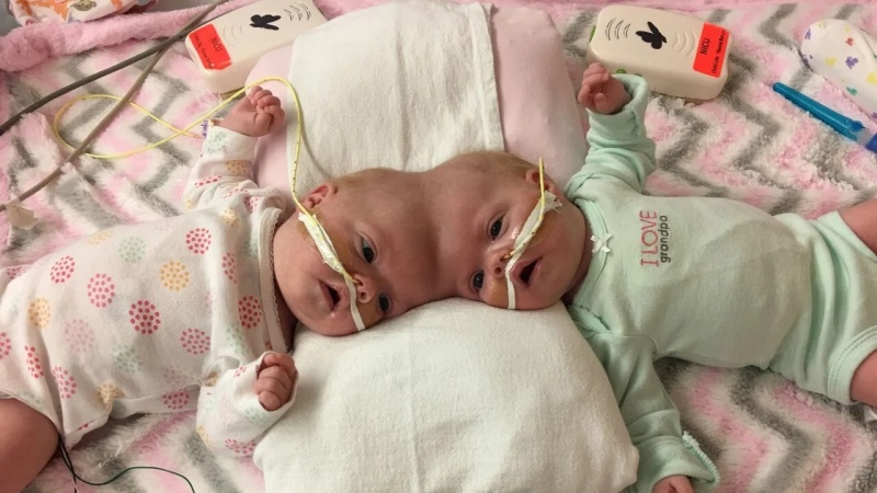 Nacieron siamesas, las separaron y consiguieron aprobar sus primeros años de colegio